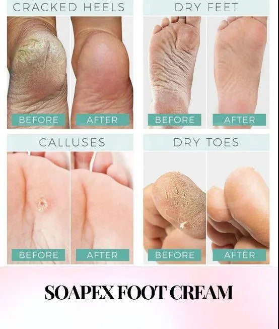 Soapex Foot Cream for Dry Cracked Heels & Feet